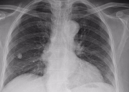 شیوع سل در سیستان‌وبلوچستان بالاتر از میانگین کشوری