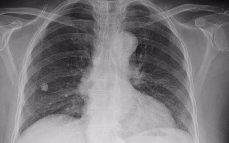 شیوع سل در سیستانوبلوچستان بالاتر از میانگین کشوری