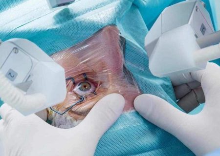 جراحی موفق آب‌مروارید زوج سالمند در ایرانمهر سراوان